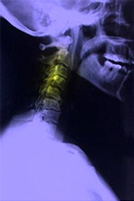 Auto Injury