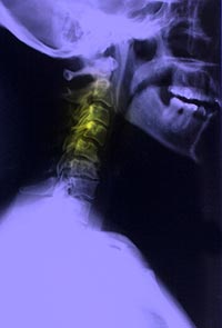 Underwood Chiropractic Clinic can help you recover from accident-related injuries.